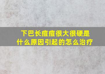 下巴长痘痘很大很硬是什么原因引起的怎么治疗