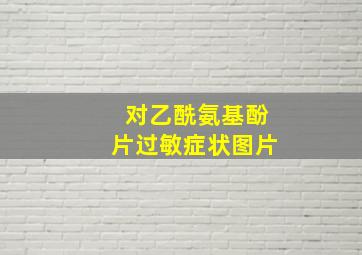 对乙酰氨基酚片过敏症状图片