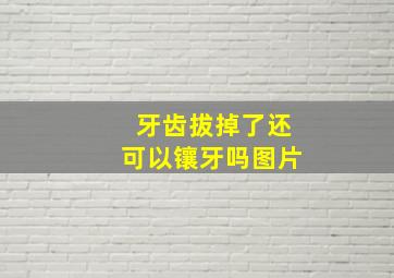 牙齿拔掉了还可以镶牙吗图片