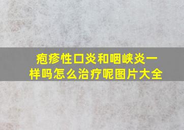 疱疹性口炎和咽峡炎一样吗怎么治疗呢图片大全