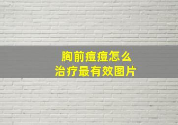 胸前痘痘怎么治疗最有效图片