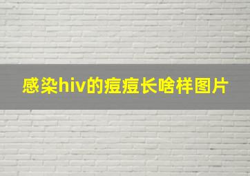 感染hiv的痘痘长啥样图片