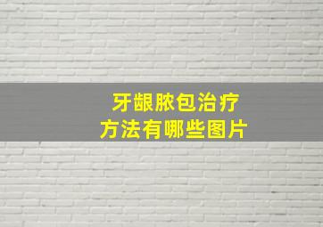 牙龈脓包治疗方法有哪些图片