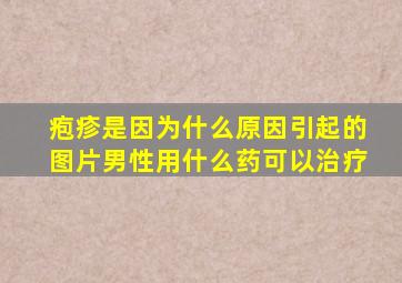 疱疹是因为什么原因引起的图片男性用什么药可以治疗