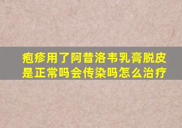 疱疹用了阿昔洛韦乳膏脱皮是正常吗会传染吗怎么治疗